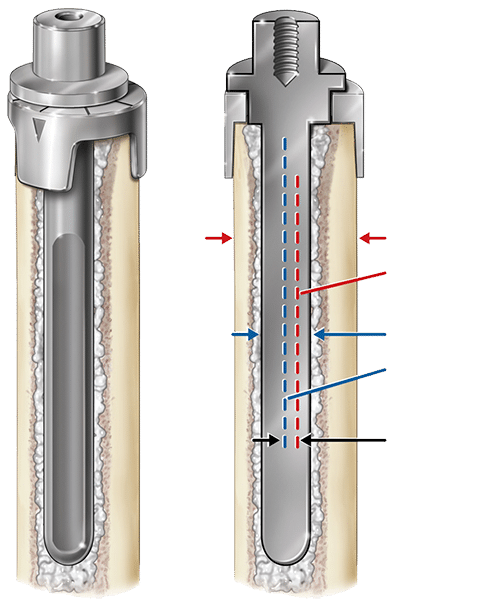 Equinoxe Humeral Reconstruction Prosthesis