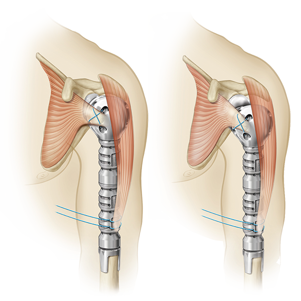 Equinoxe Humerus Rekonstruktionsprothese HRP